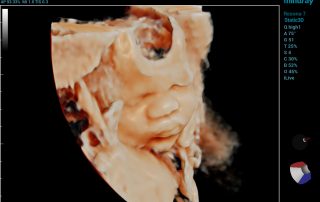 Resona 7 Image: 3D of baby face using D8-4U