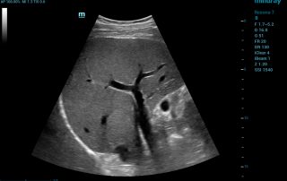 Resona 7 Image: B-mode of liver using SC6-1U