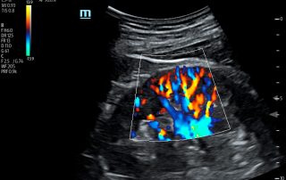 TE7 Image: Color Doppler of renal using C5-1s