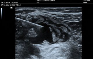 ME8 Image: brachial plexus