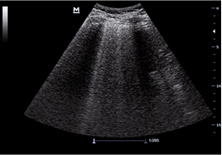 b lines in lungs