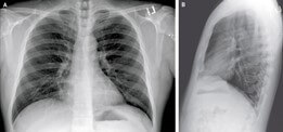 chest x-ray