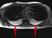 fluid in chest