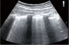 lung xray scan