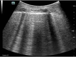 ultrasound lungs