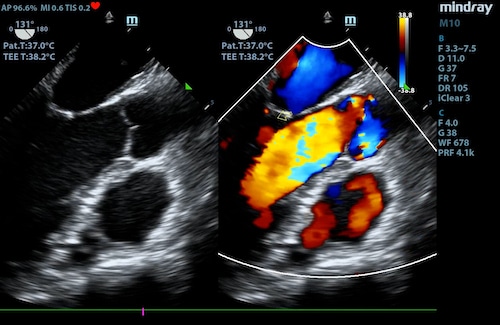 tee ultrasound